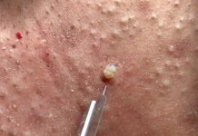 Cystic Extraction Whiteheads