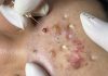 Cystic Acne Blackheads Extraction Whiteheads