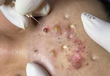 Cystic Acne Blackheads Extraction Whiteheads