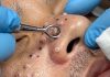Cystic Blackheads Extraction Whiteheads