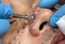 Cystic Blackheads Extraction Whiteheads