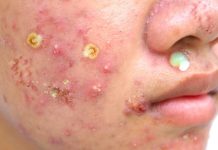 Cystic Acne Extraction Blackheads