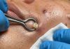 Cystic Extraction Whiteheads Removal