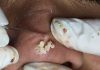 Cystic Extraction Whiteheads