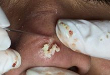 Cystic Extraction Whiteheads