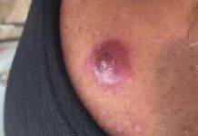 Big Cystic Blackheads Extraction