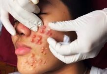 Cystic Acne Blackheads Extraction