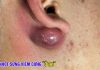 Big Cystic Blackheads Extraction