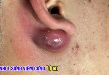 Big Cystic Blackheads Extraction