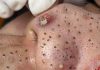 Big Cystic Blackheads Extraction