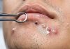 Blackheads Extraction Whiteheads