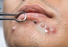 Blackheads Extraction Whiteheads
