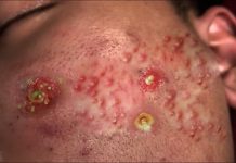 Cystic Acne Blackheads Extraction