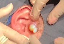 Big Cystic Extraction Whiteheads