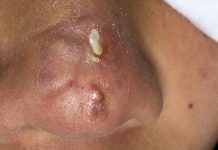 Cystic Extraction Whiteheads