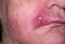 Cystic Extraction Whiteheads