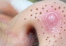 Big Cystic Blackheads