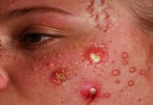 Cystic Acne Extraction Blackheads