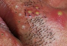 Blackheads Extraction Whiteheads
