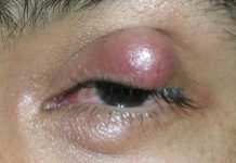 Big Cystic Blackheads