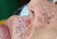 Acne Blackheads Extraction