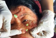 Cystic Acne Blackheads Extraction