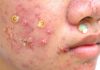 Acne Blackheads Whiteheads