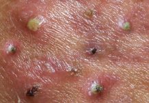 Blackheads Extraction Blackheads