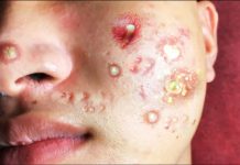 Acne Blackheads Extraction