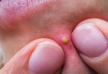 Extraction Pimple Popping