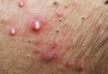 Cystic Acne Blackheads Extraction