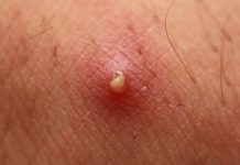 Blackheads Extraction