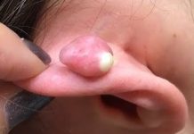 Cystic Blackheads Whiteheads