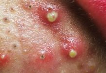 Big Cystic Blackheads Extraction