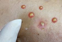 Acne Blackheads Extraction Whiteheads