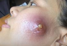 Big Cystic Acne Blackheads Extraction