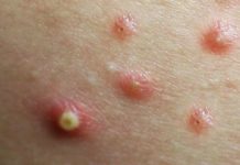 Extraction Blackheads Whiteheads