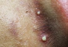 Cystic Blackheads and Whiteheads