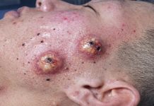 Big Cystic Blackheads Extraction