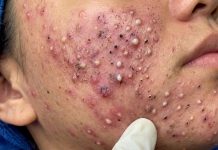 Cystic Acne Blackheads Extraction