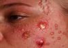 Cystic Acne Blackheads Whiteheads