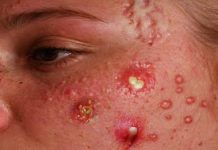 Cystic Acne Blackheads Whiteheads