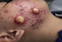 Big Cystic Acne Blackheads Extraction