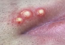 Big Cystic Extraction Whiteheads