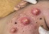 Big Cystic Acne Blackheads Extraction