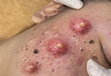 Big Cystic Acne Blackheads Extraction