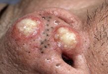 Big Blackheads Extraction