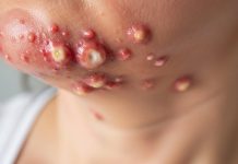 Cystic Blackheads Extraction