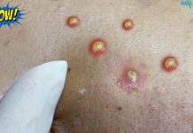 Acne Blackheads Extraction Whiteheads