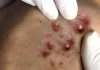 Cystic Acne Blackheads Extraction